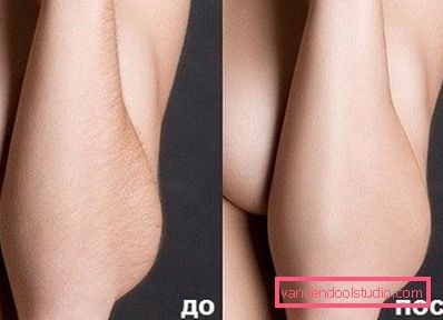 ženska podlaktica prije i poslije lijeka ženska podlaktica prije i poslije lijeka