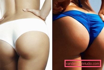 gluteoplastika