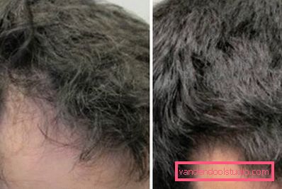 bald spot bald spot